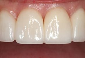 Sajoo Smiles | Dental Bridges, Implant Restorations and Dentures