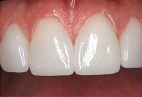 Sajoo Smiles | Implant Restorations, Dentures and Veneers